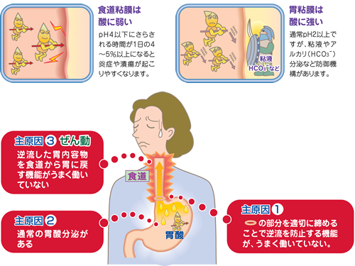 性 自然 逆流 治癒 炎 食道